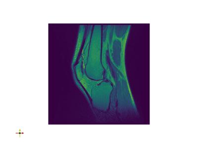 Baseline: pyvista-examples-downloads-download_knee-3c1adcad3357d35d_00_00_vtksz